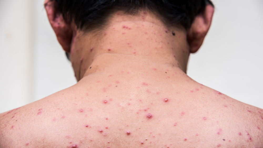 Getting chicken pox twice adults