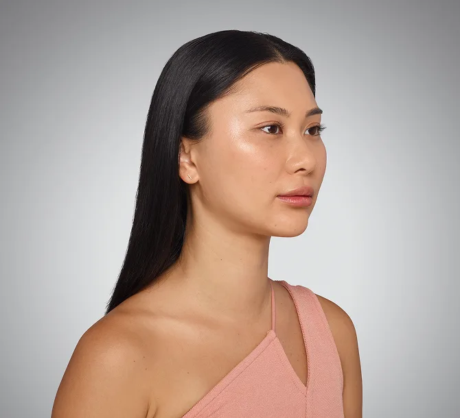 After dermal filler treatment
